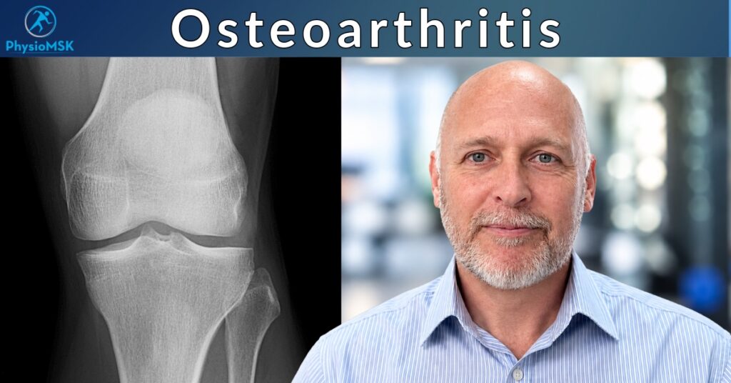 Illustration of a knee X-ray in an picture depicting osteoarthritis, with specialist MSK physiotherapist Stephen Bunting