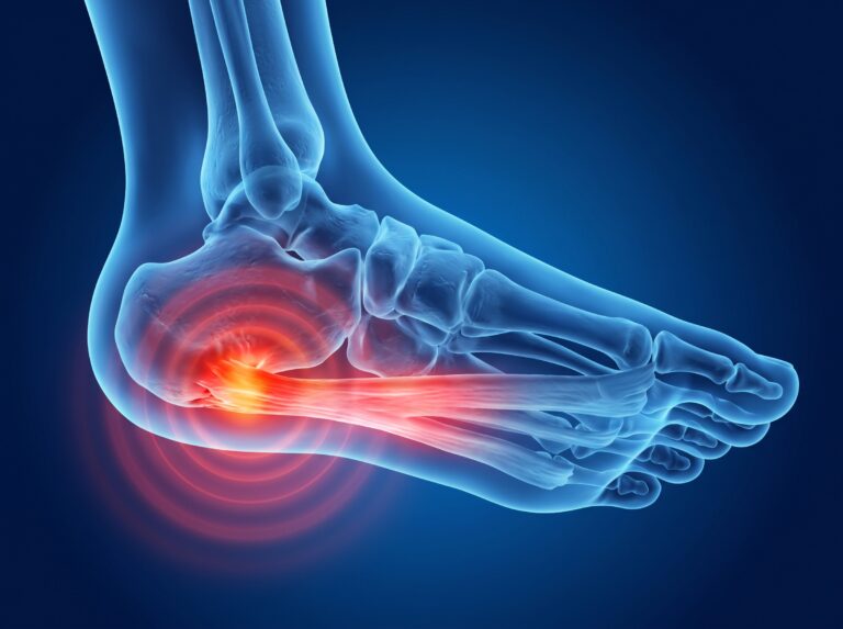 an anatomical image showing the symptoms of plantar fasciitis / plantar heel pain