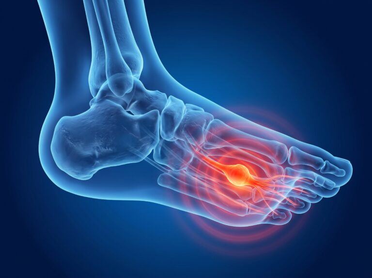 an anatomical image showing a mortons neuroma