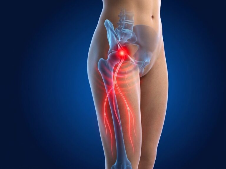an anatomical image showing meralgia paraesthetica of the lateral femoral cutaneous nerve