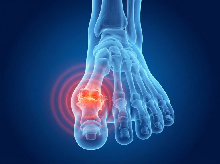 am anatomical image showing big toe MTP joint arthritis / hallux rigid
