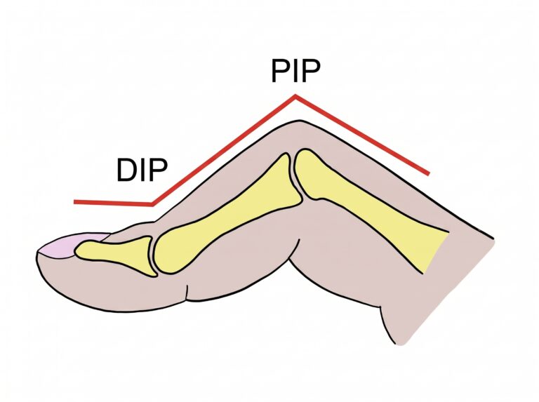 an anatomical image showing a finger boutonnière deformity