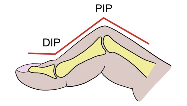 Degete Common Finger Deformities – PhysioMSK