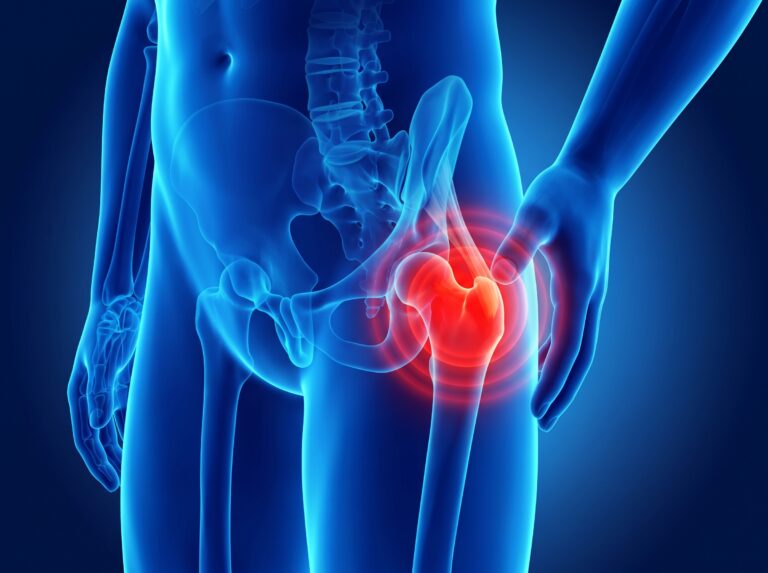 an anatomical image showing snapping hip syndrome