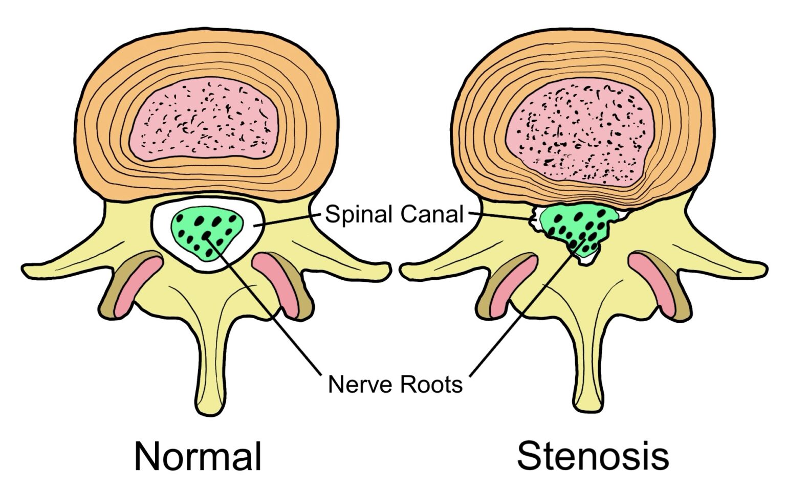 Sciatica (Lumbar Radiculopathy) – PhysioMSK