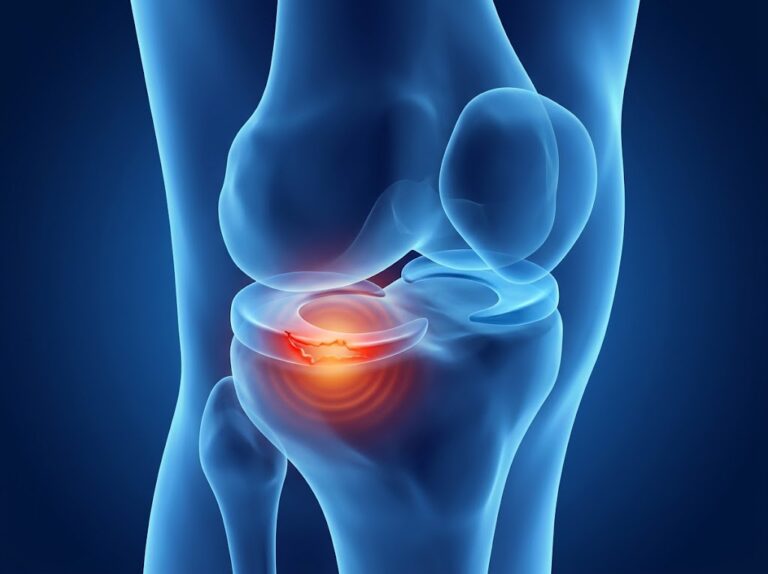 an anatomical image showing a knee meniscal tear