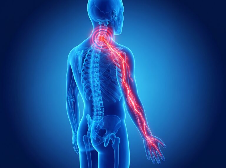 anatomical image showing a trapped neck nerve (cervical radiculopathy)