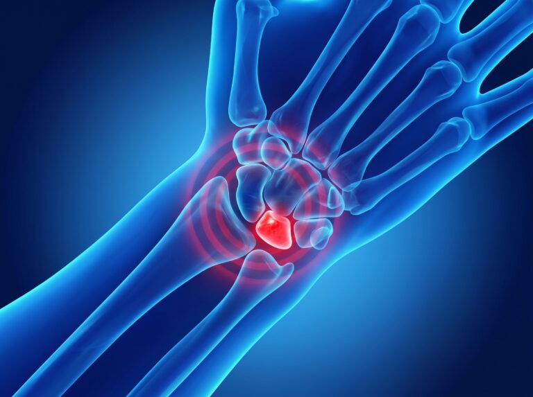 an anatomical image showing kienbocks disease, highlighting the lunate bone.