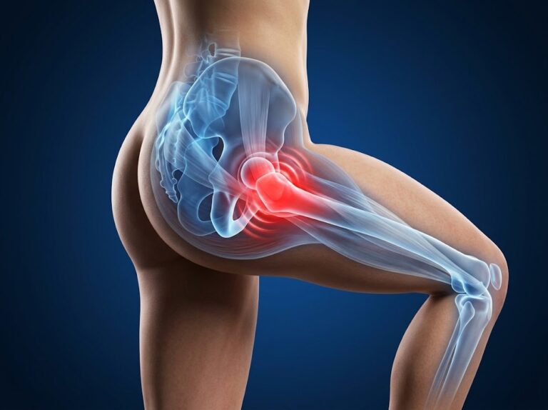 an anatomical image showing snapping hip syndrome
