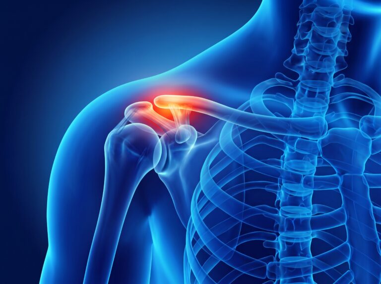 an anatomical image of the shoulder depicting acromioclavicular joint pain