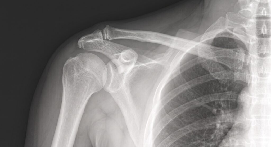 X-ray showing ac joint osteoarthritis