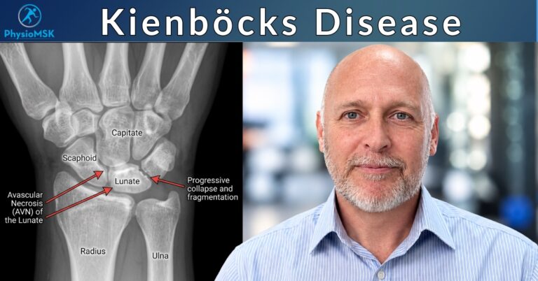 Illustration of Kienböck's disease (lunate avascular necrosis) on an X-Ray, with specialist MSK physiotherapist Stephen Bunting.