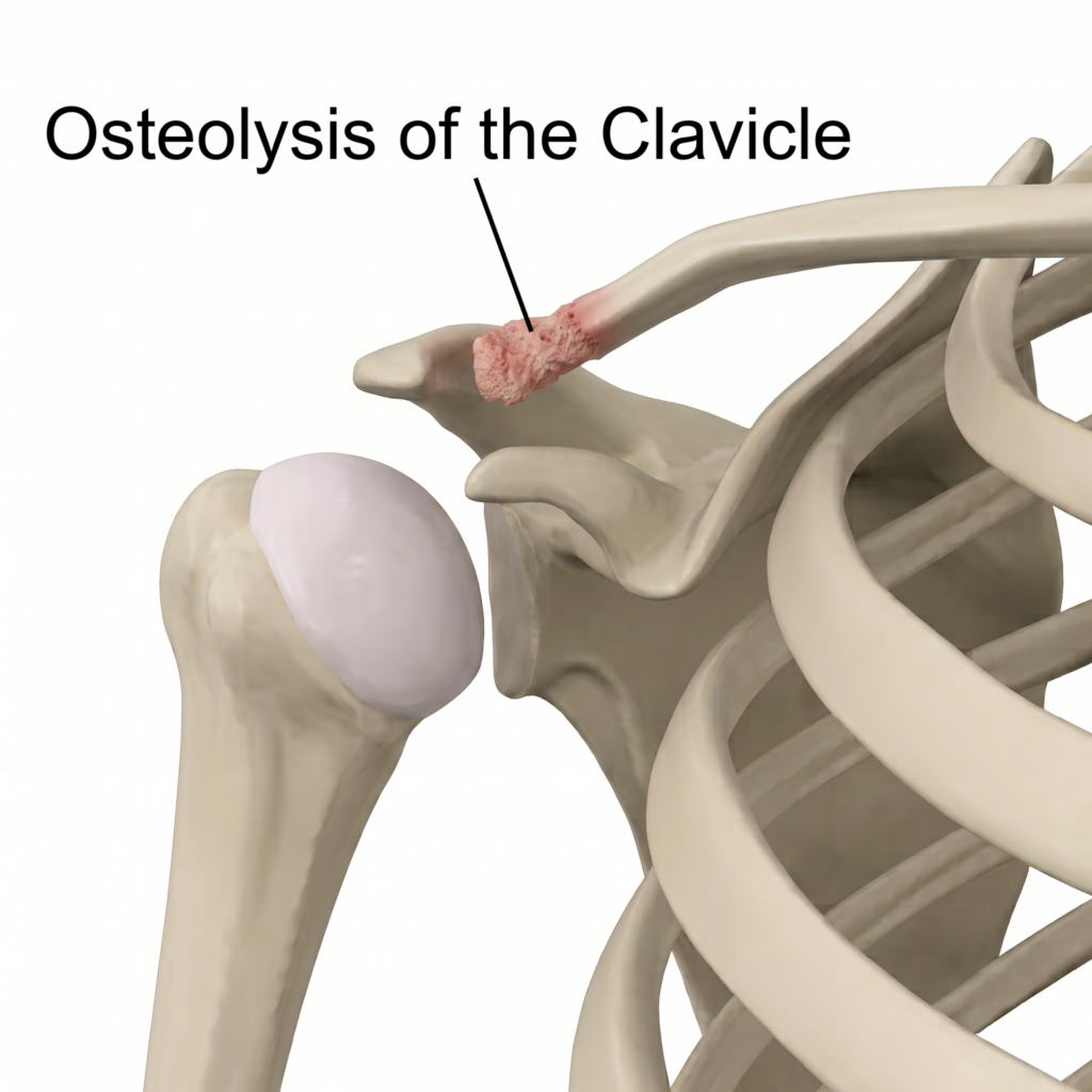 osteolysis of the clavicle