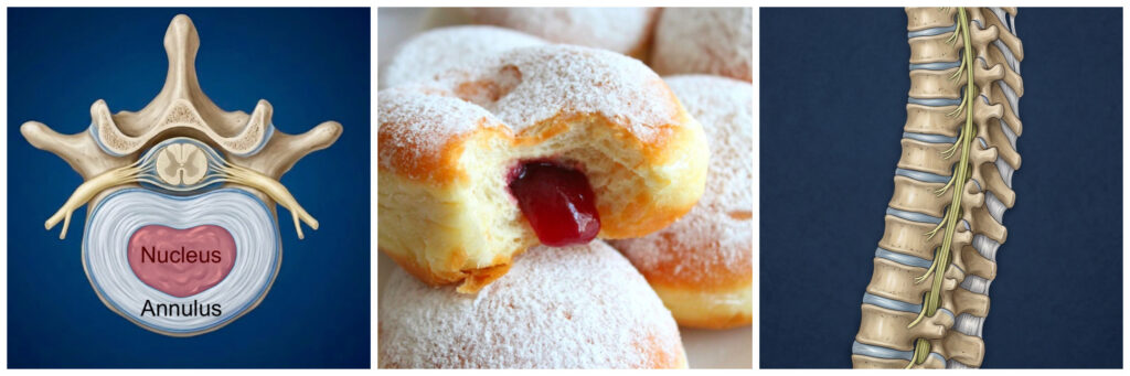 a picture of 3 images showing a spinal disc with nucleus and annulus, a jam donut (which resembles a disc) and the spinal column showing multiple discs and vertebra