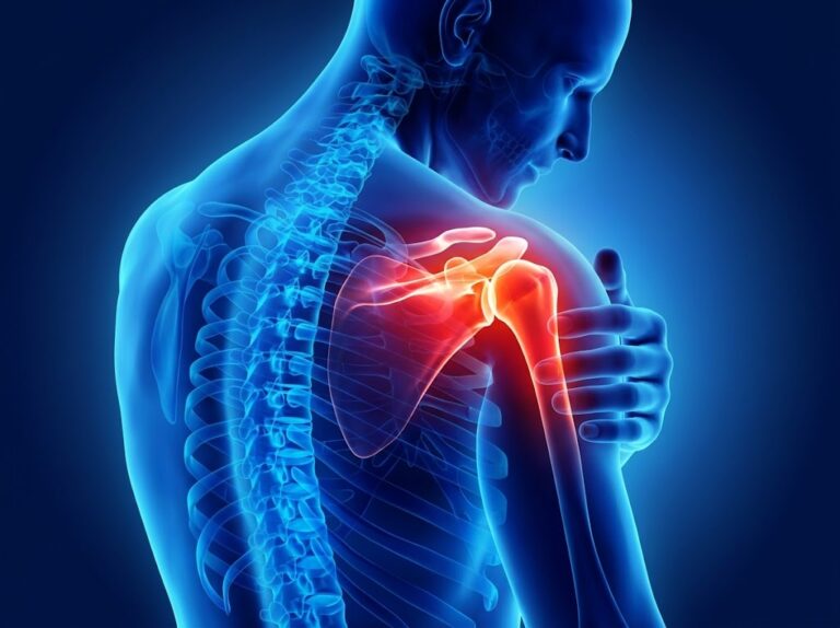 an anatomical image of the shoulder depicting a frozen shoulder