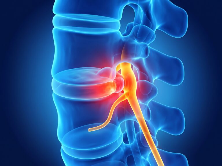 an anatomical image of a herniated lumbar disc (slipped disc)