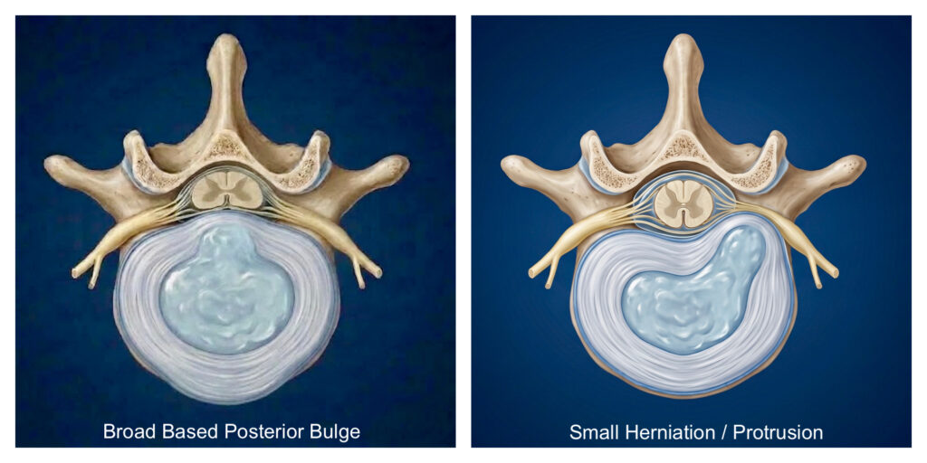 a broad based posterior disc bulge and a small disc herniation / protrusion